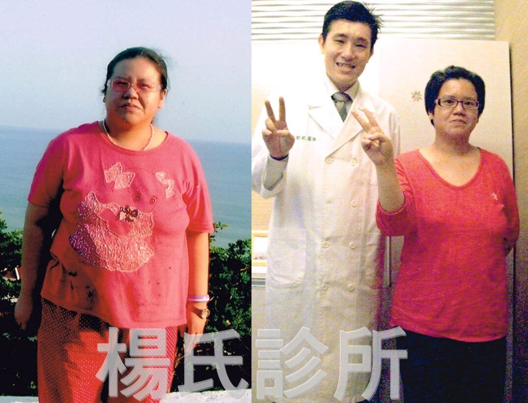 賴斯敏醫師讓我甩去22公斤的蛻變